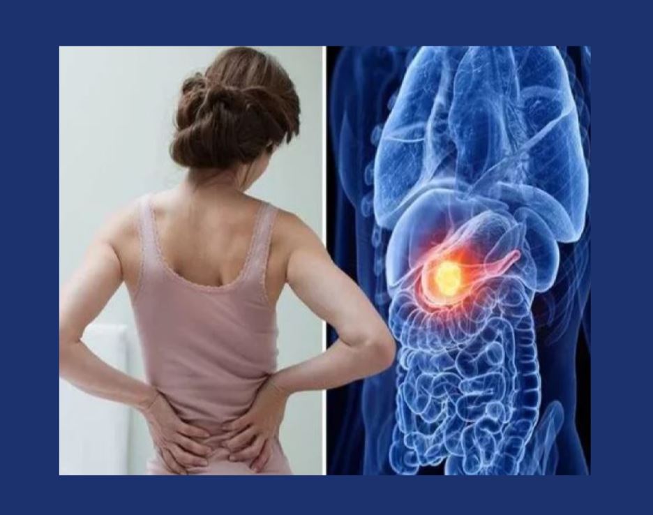 Los principales síntomas de cáncer de páncreas que pueden pasar desapercibidos